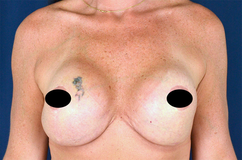 Breast Implant Revision