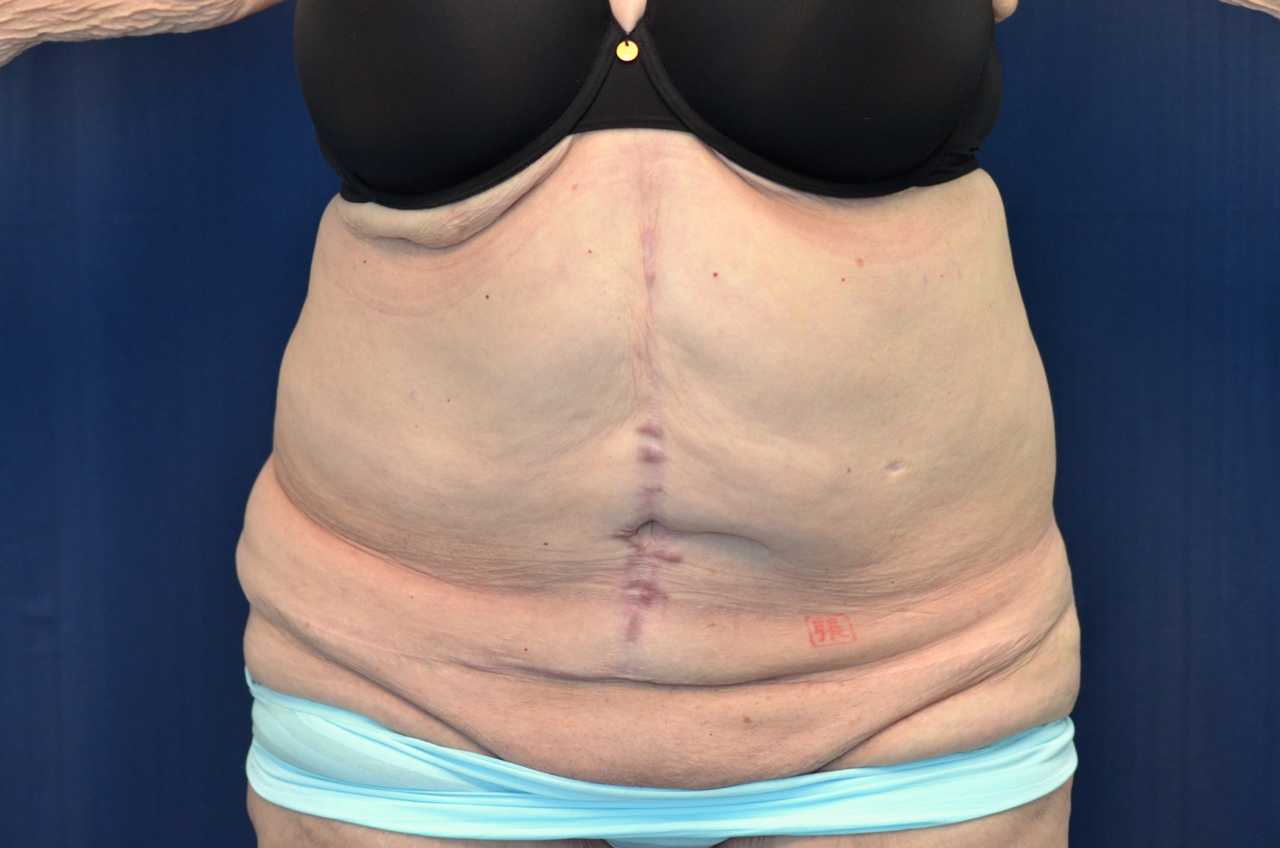 Tummy Tuck