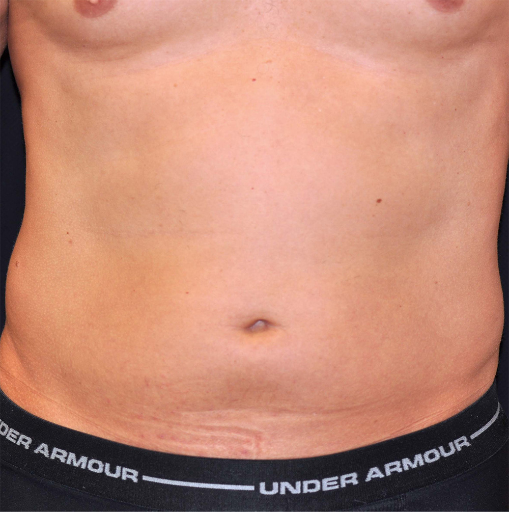 Liposuction