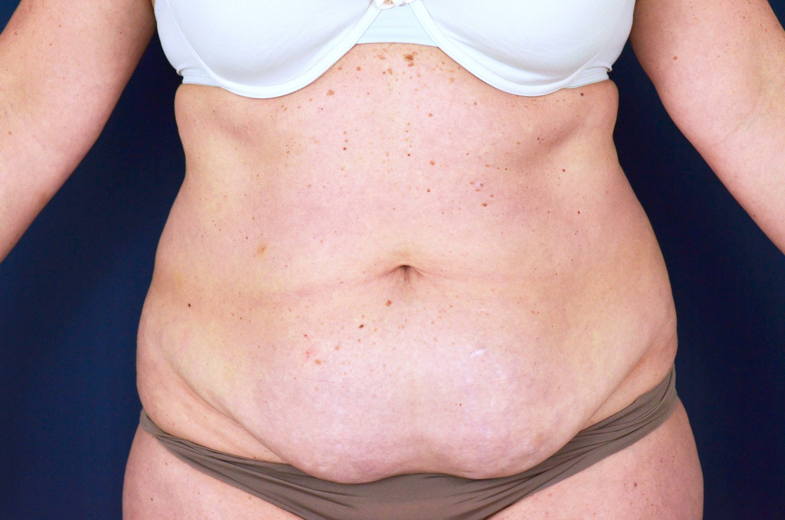 Tummy Tuck