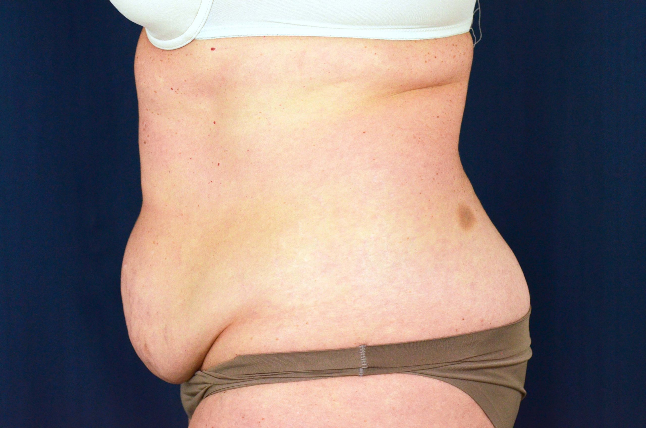 Tummy Tuck