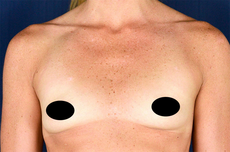 Breast Augmentation Before and After