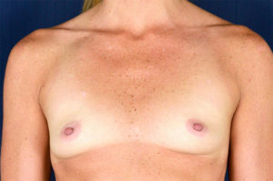 Le Spa Plastic Surgery Before and After Photos