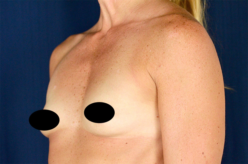 Breast Augmentation Before and After