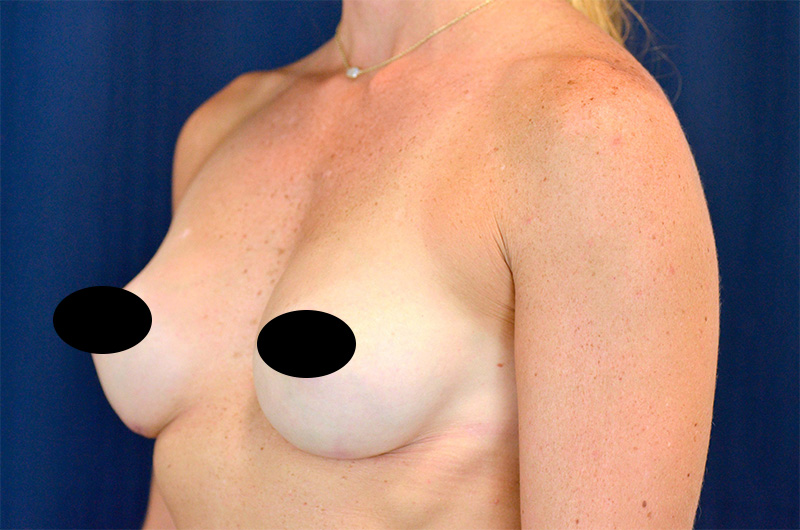 Breast Augmentation Before and After