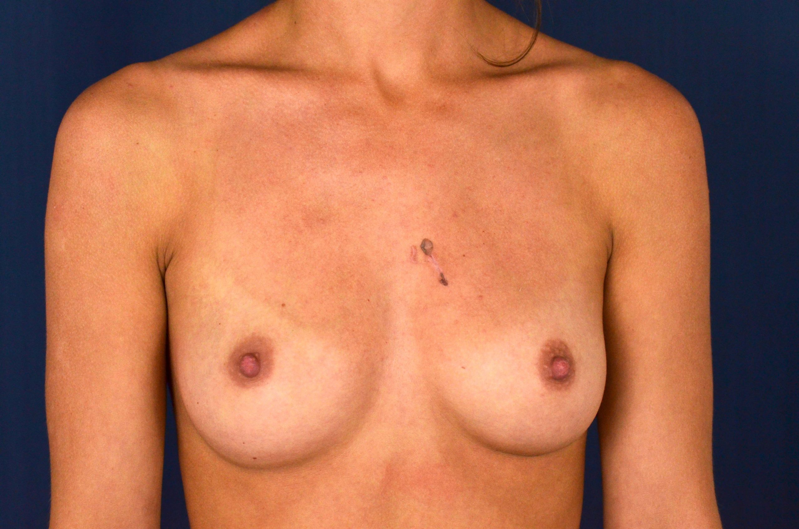 Breast Augmentation Before and After