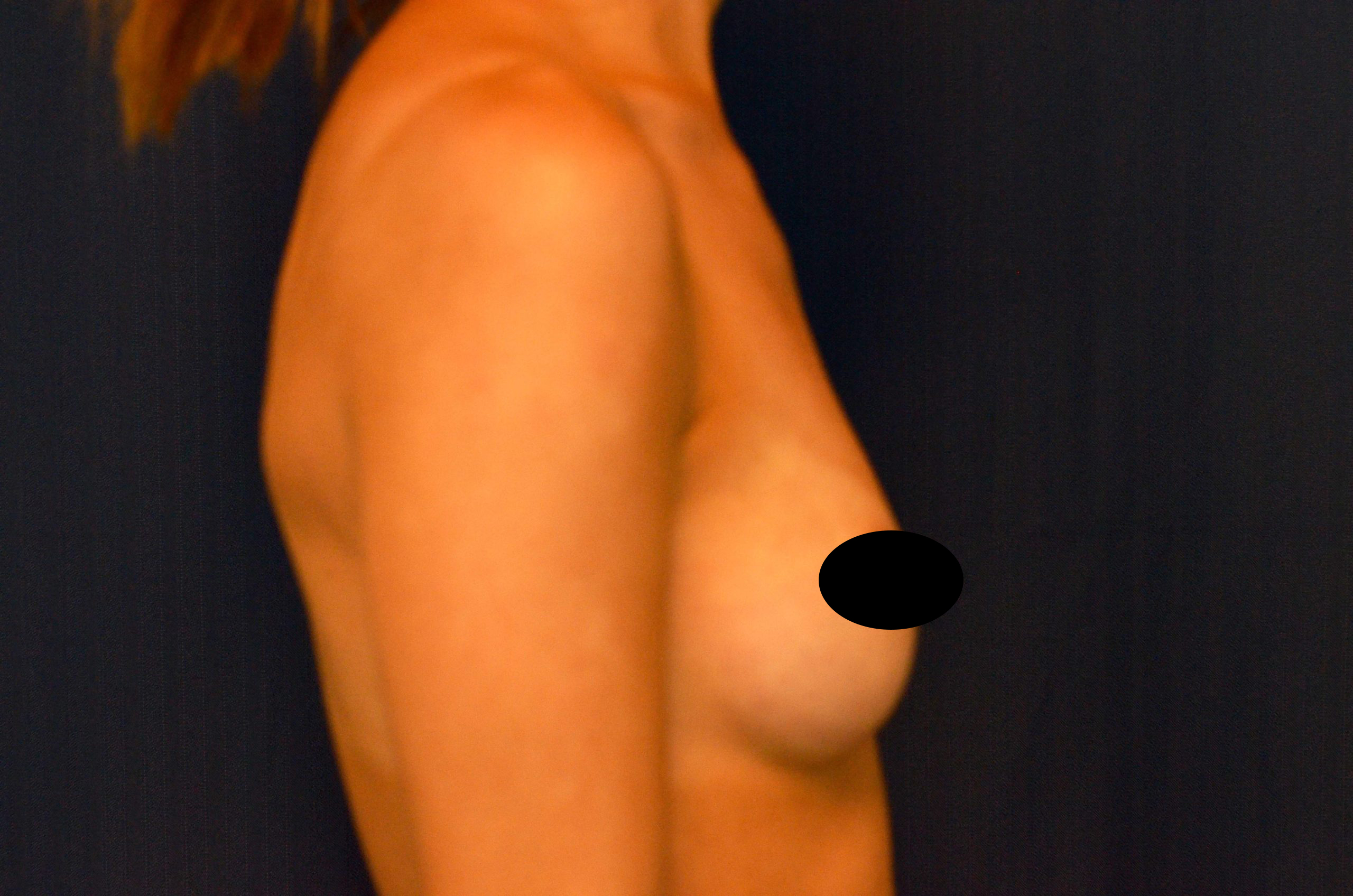 Breast Augmentation Before and After