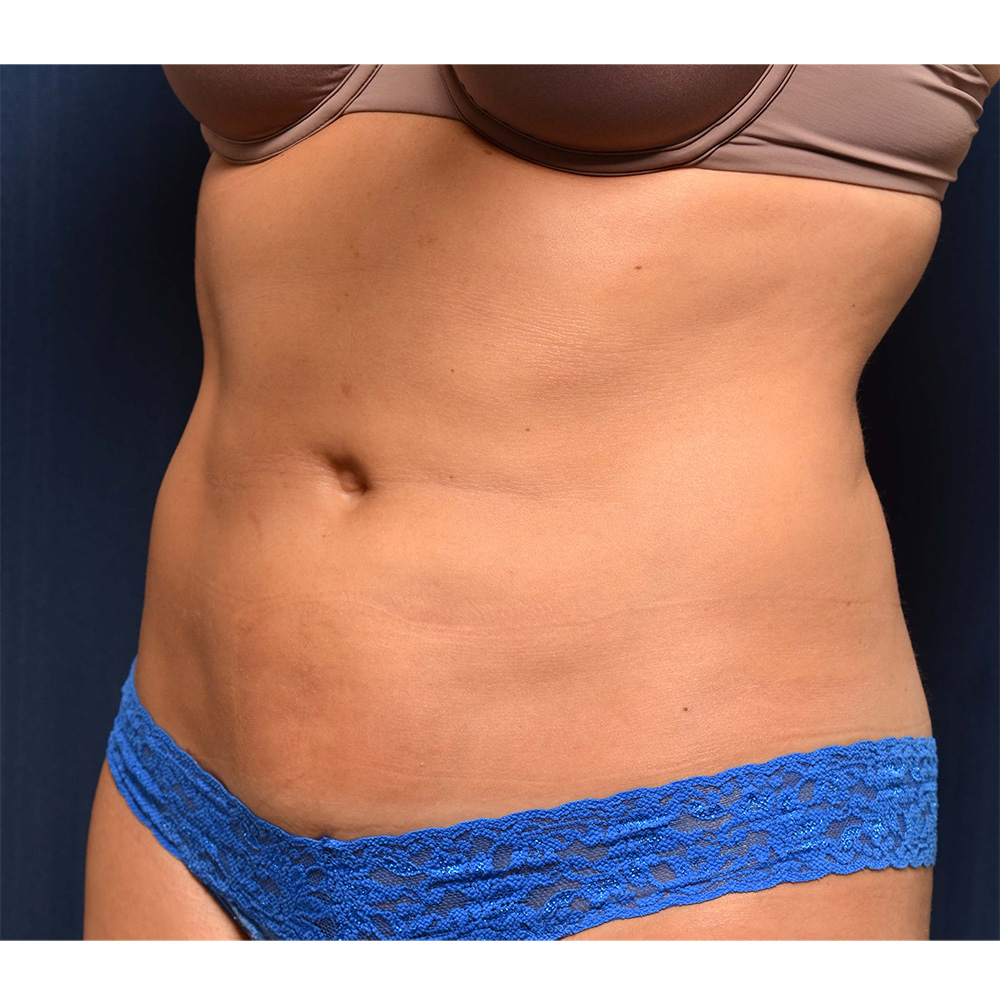 Liposuction