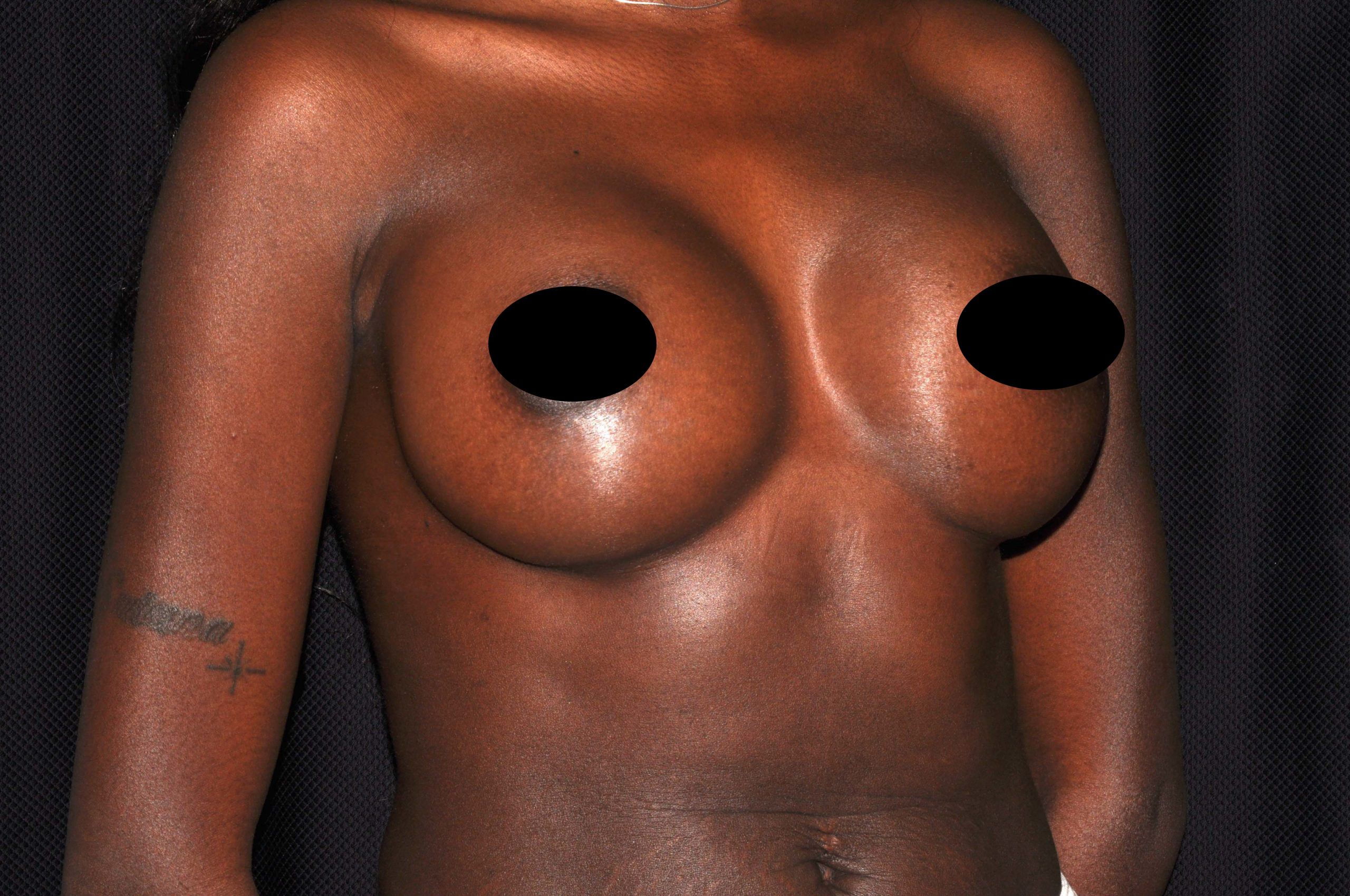 Breast Augmentation Before and After