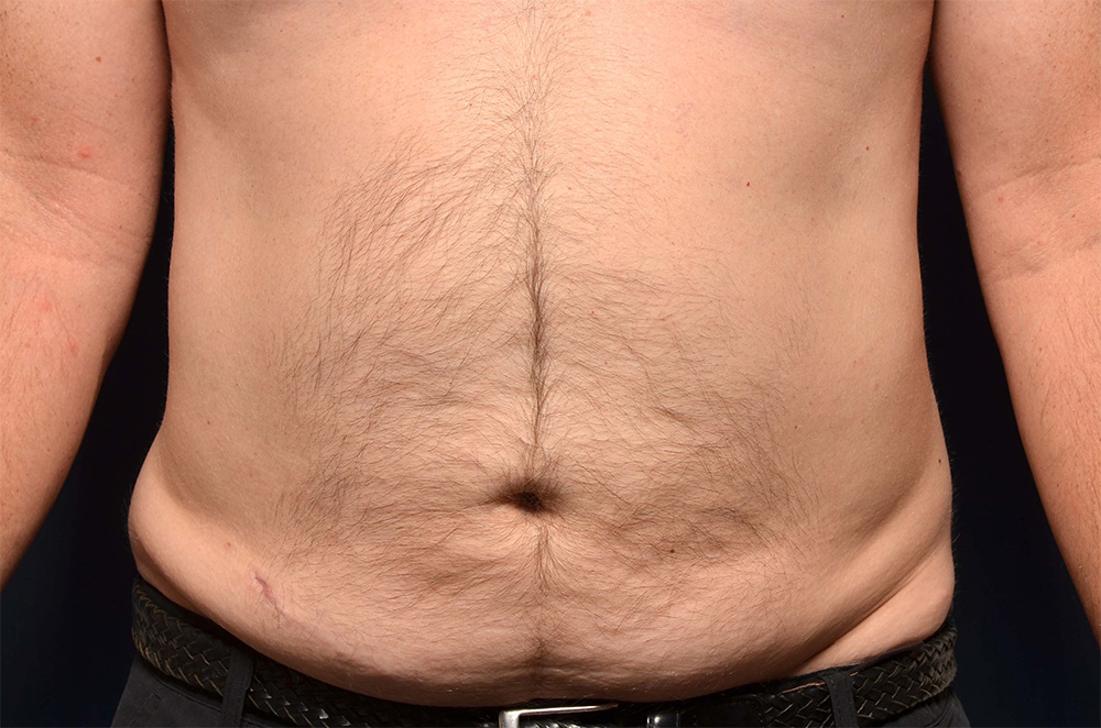 Liposuction