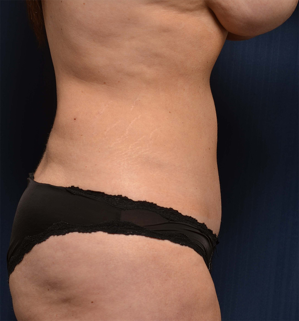 Tummy Tuck