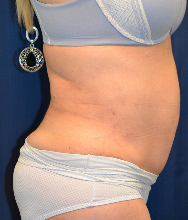 Tummy Tuck