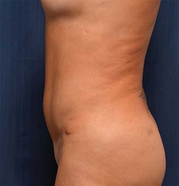 Tummy Tuck