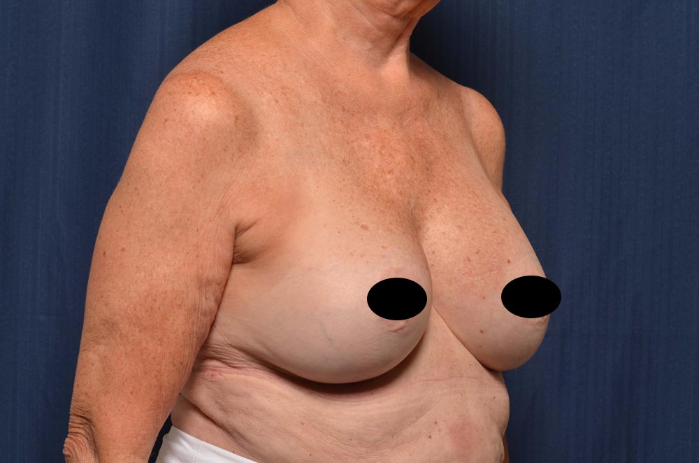 Breast Augmentation with Lift