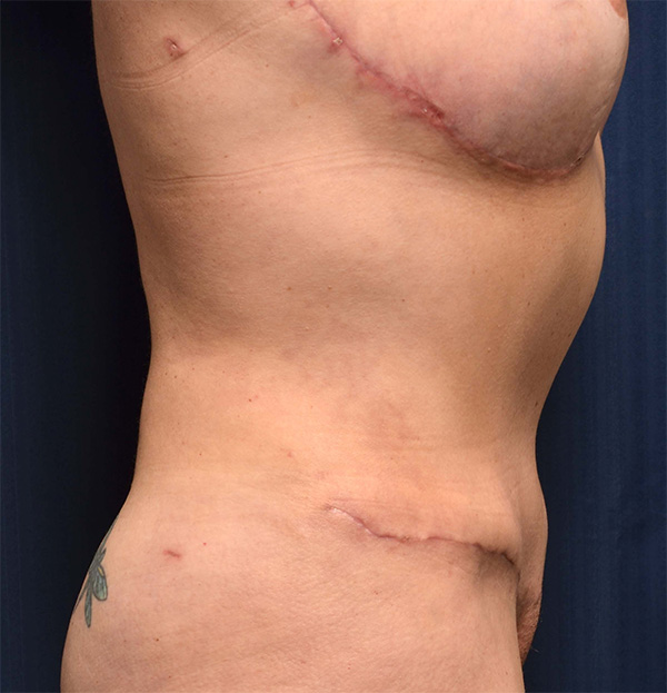 Tummy Tuck