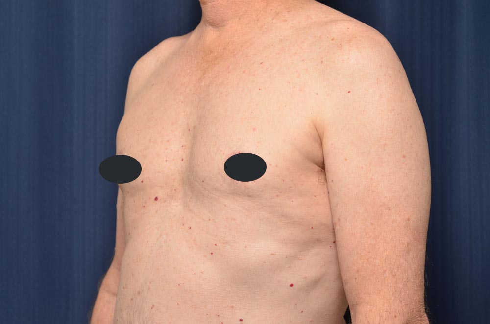 Gynecomastia