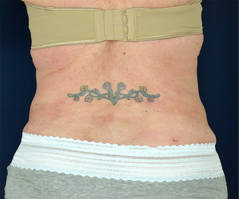 Tummy Tuck