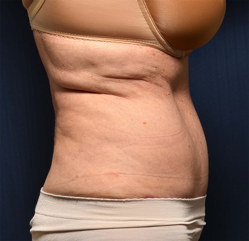 Tummy Tuck