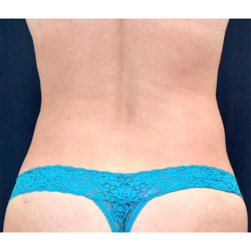 Tummy Tuck