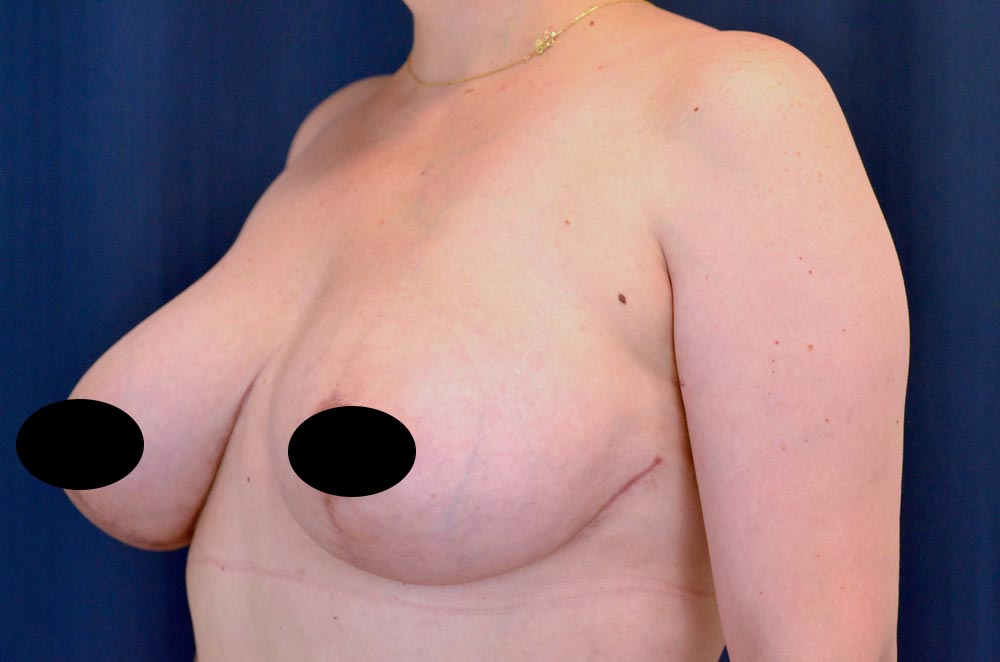 Breast Lift Reduction