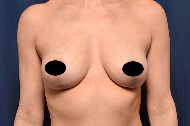 Breast Lift Reduction