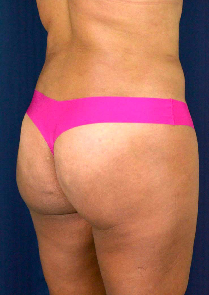 Brazilian Butt Lift Before & After