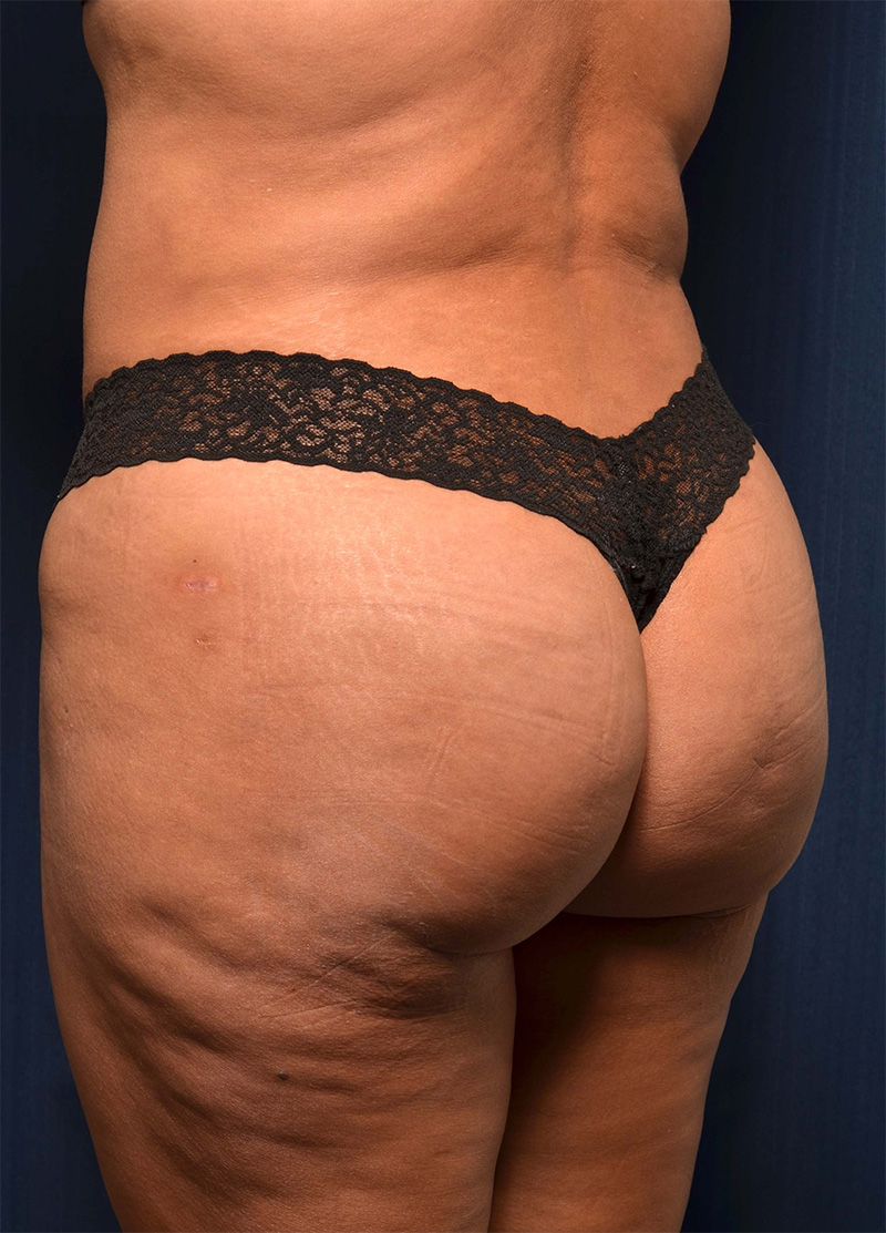 Brazilian Butt Lift Before & After