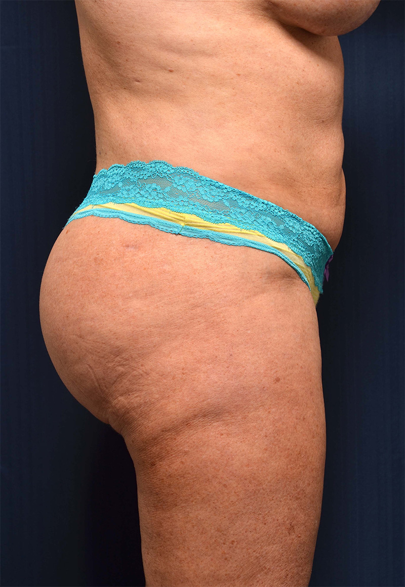 Brazilian Butt Lift Before & After