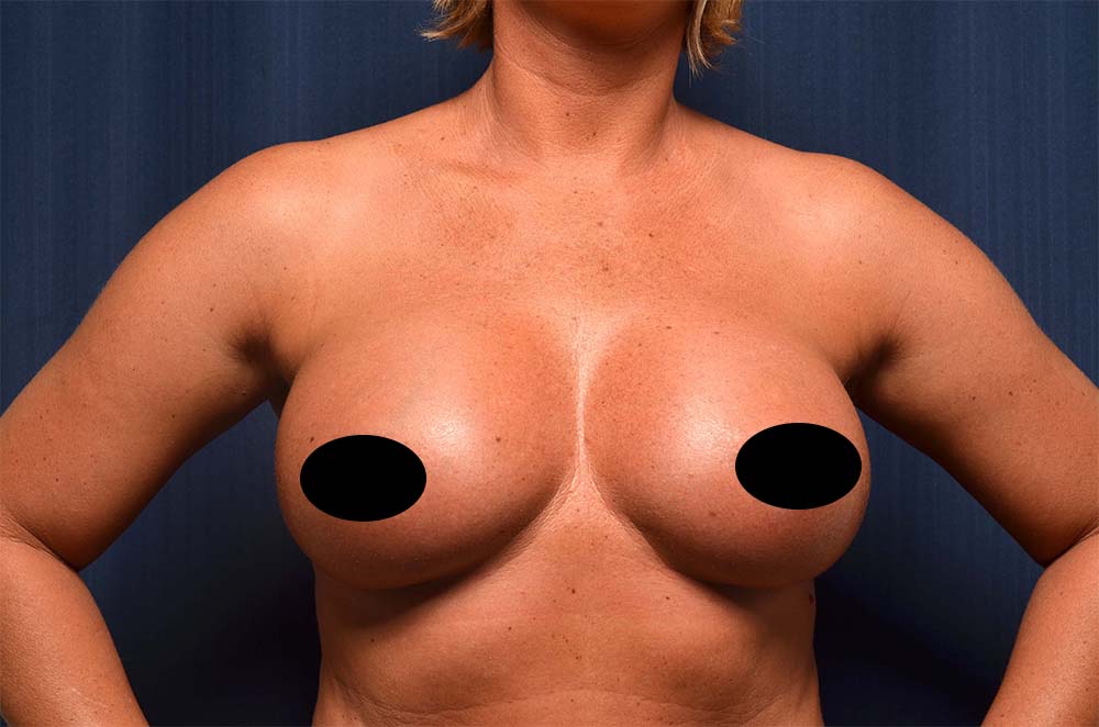 Breast Augmentation Before and After
