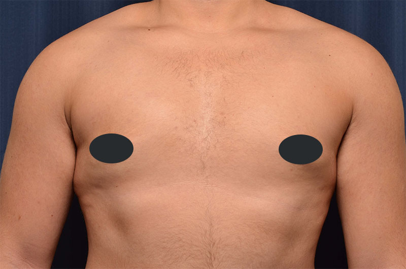 Gynecomastia