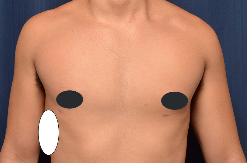 Gynecomastia