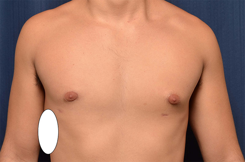 Gynecomastia