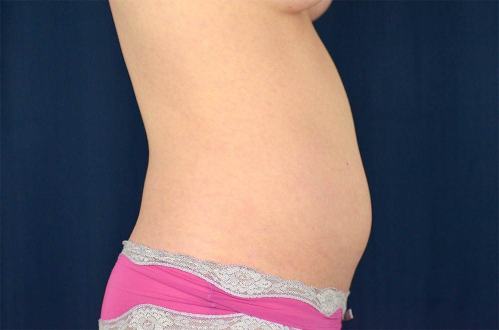 Liposuction