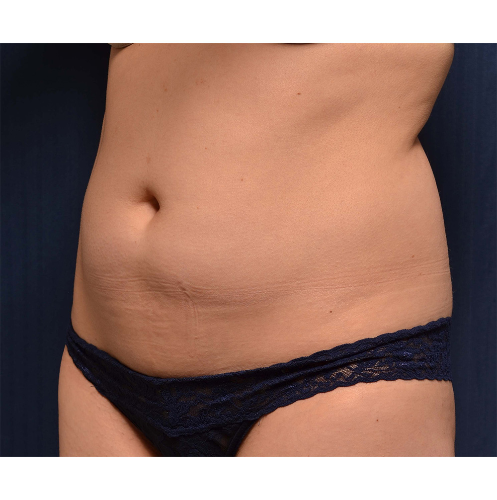 Liposuction