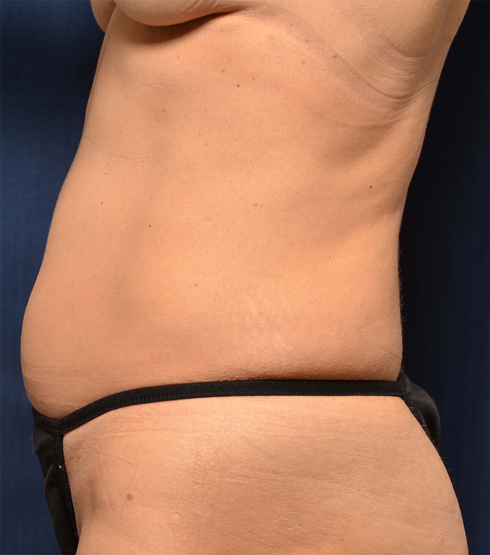 Liposuction