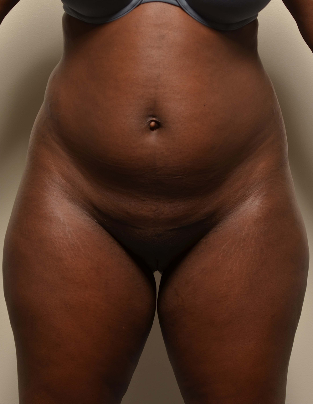 Liposuction