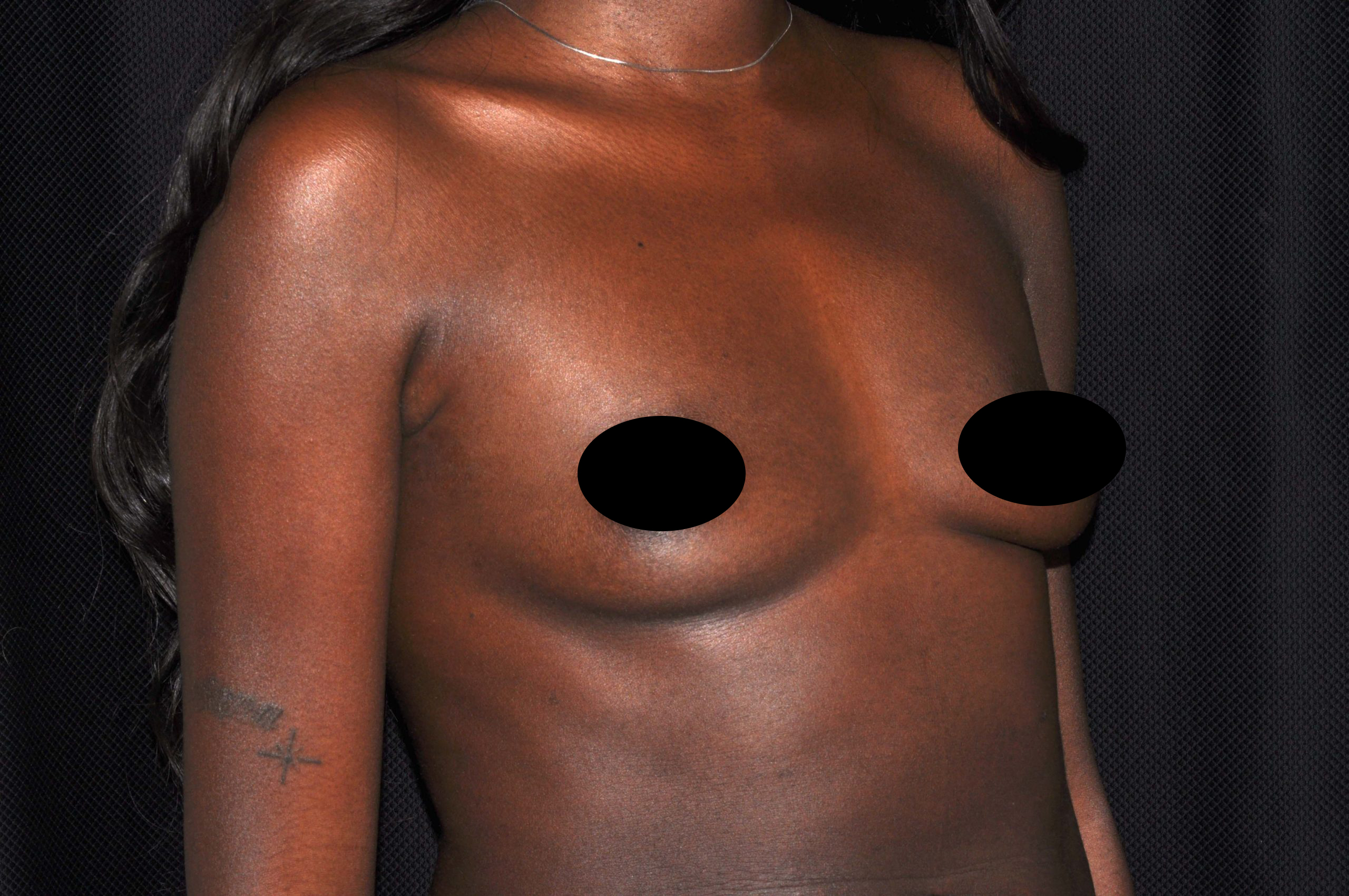 Breast Augmentation Before and After