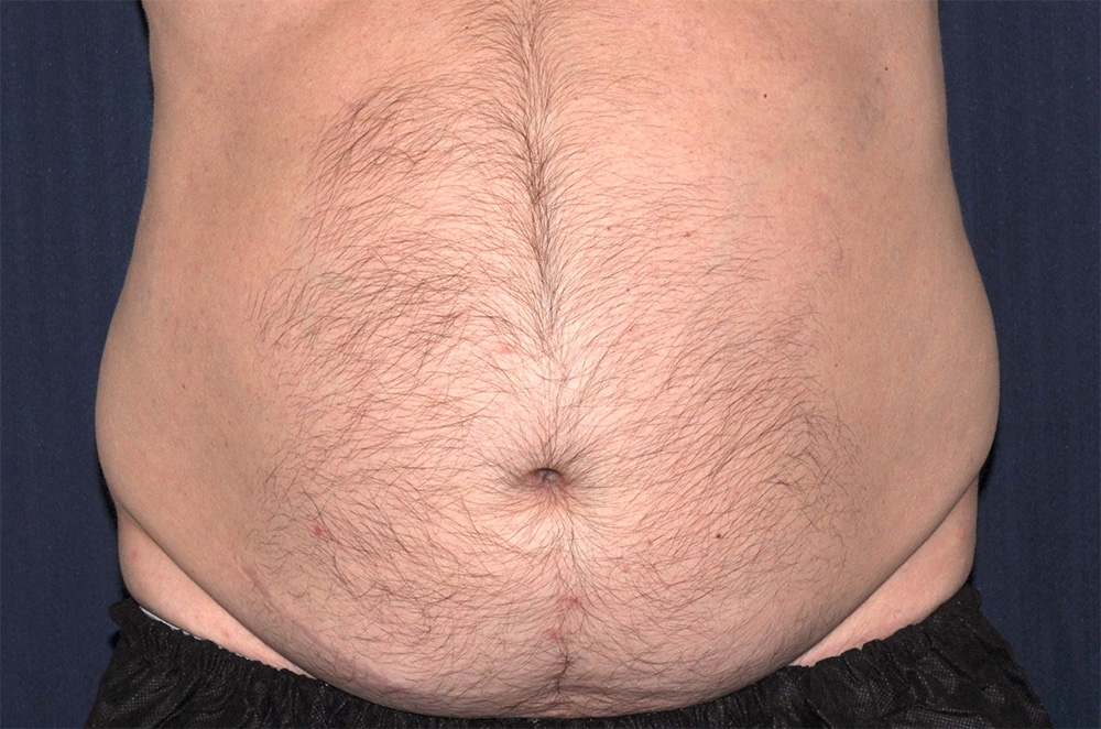 Liposuction