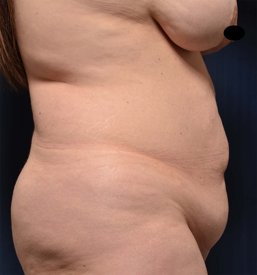 Tummy Tuck