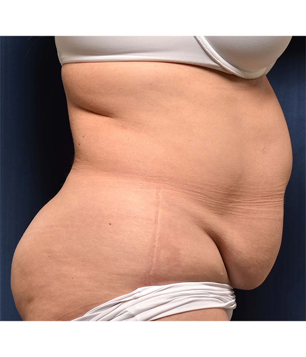 Tummy Tuck