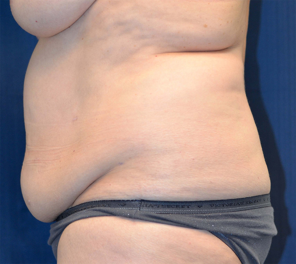 Tummy Tuck