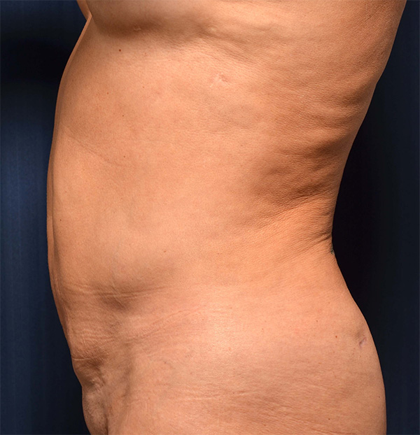 Tummy Tuck