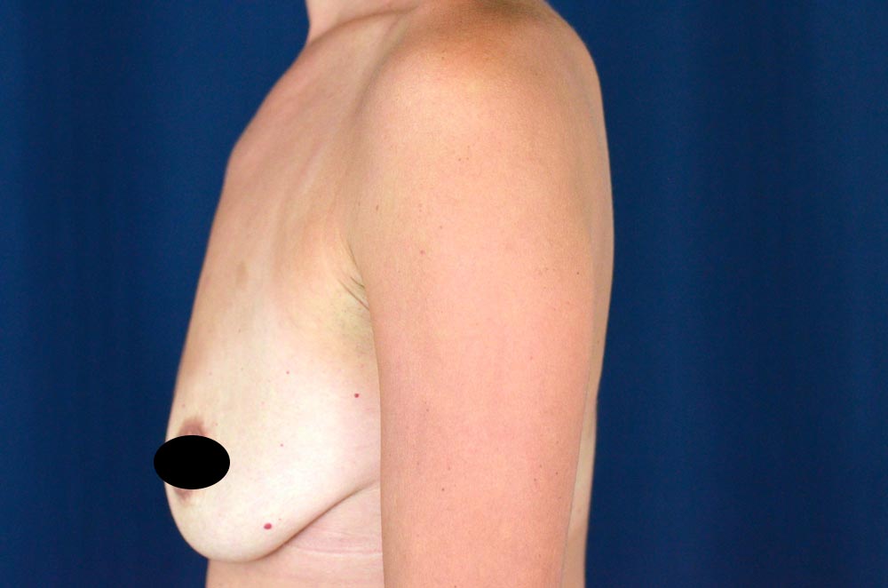 Breast Augmentation with Lift