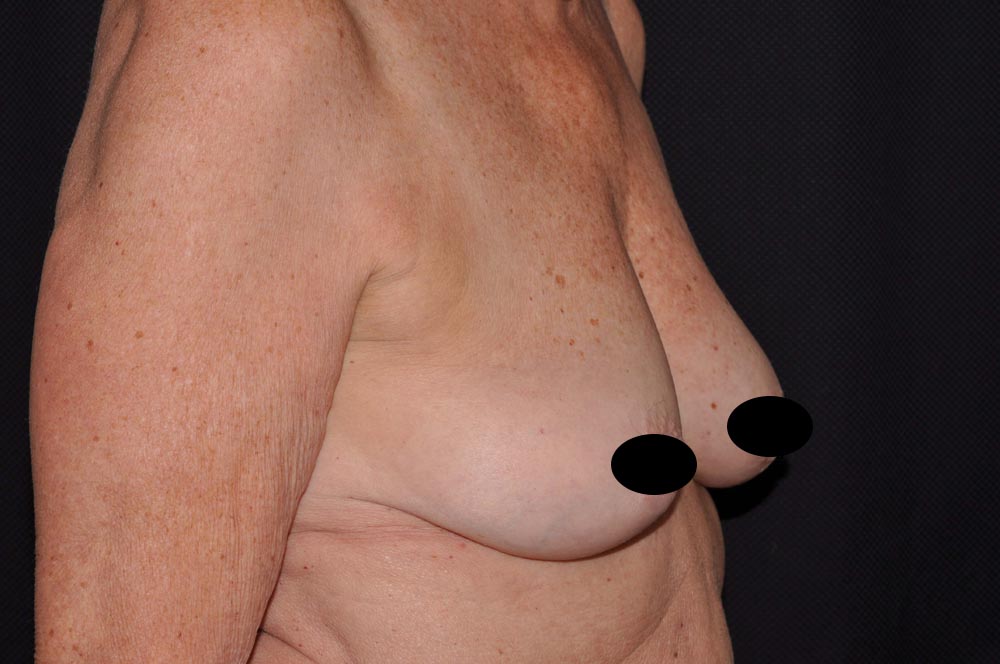 Breast Augmentation with Lift