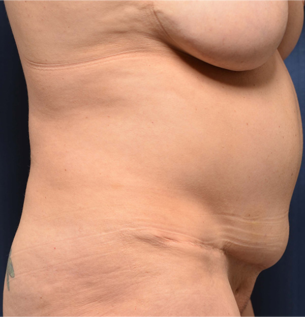 Tummy Tuck