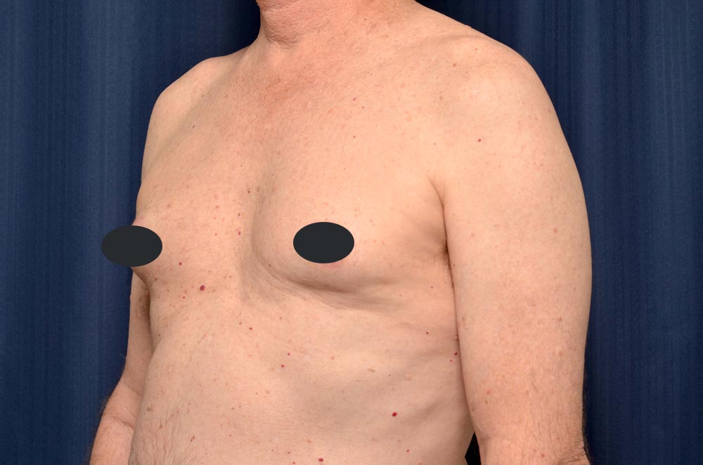 Gynecomastia