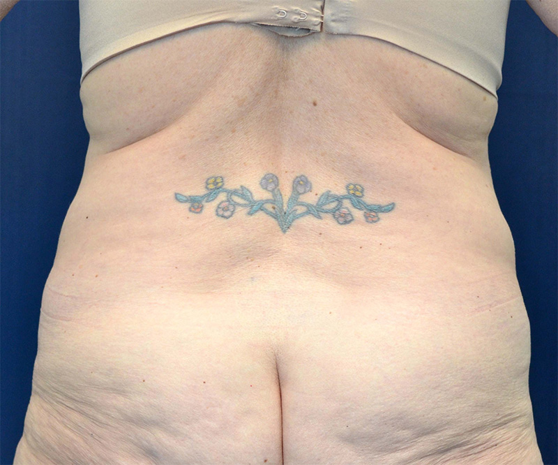 Tummy Tuck