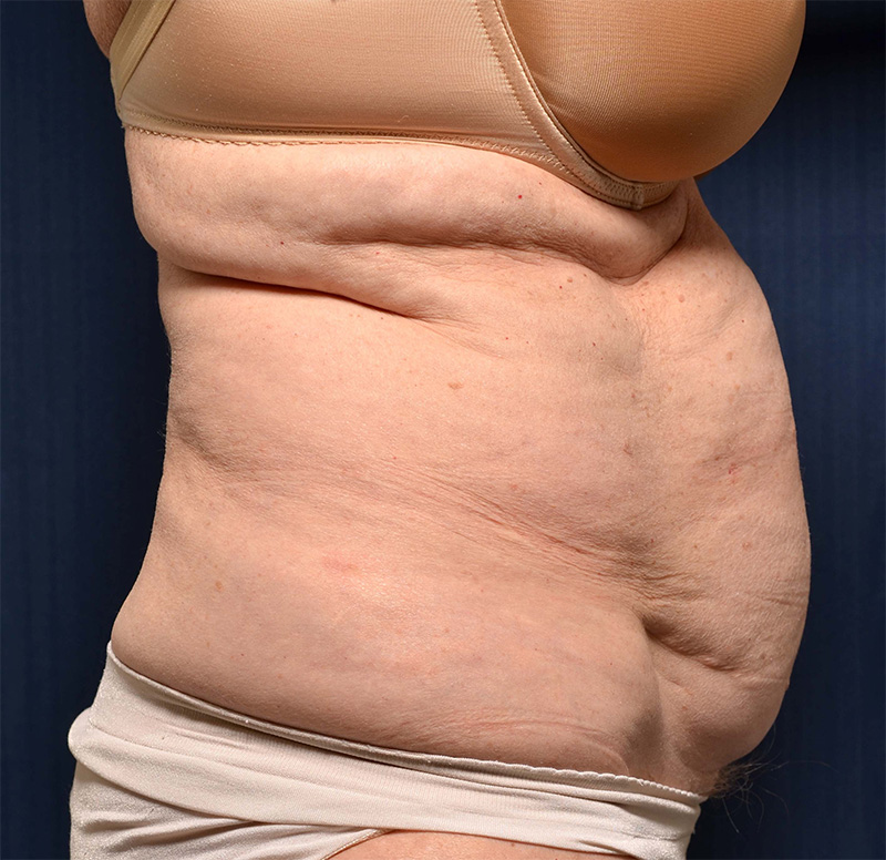 Tummy Tuck