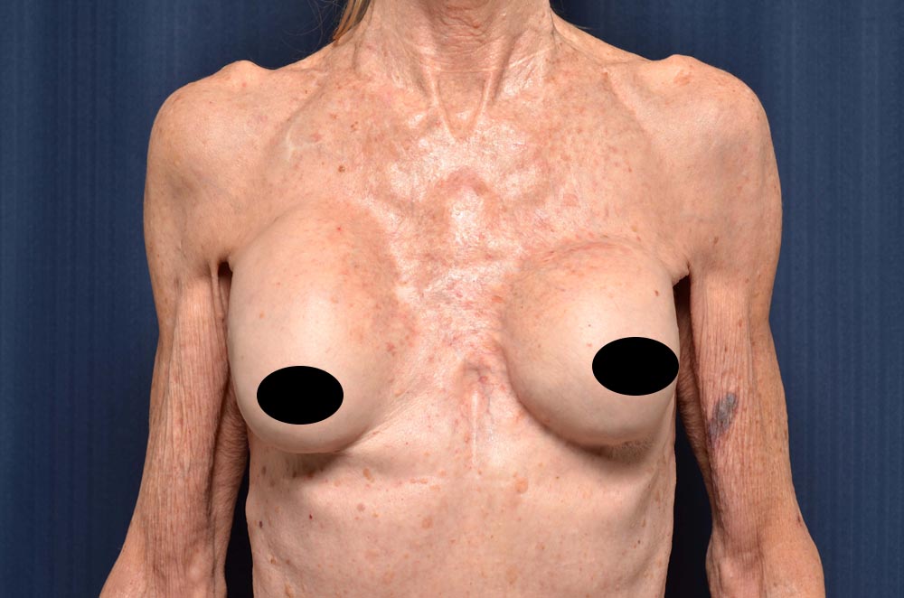 Breast Implant Revision