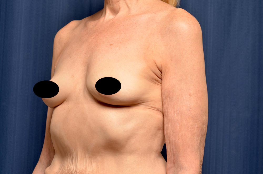 Breast Augmentation Before and After